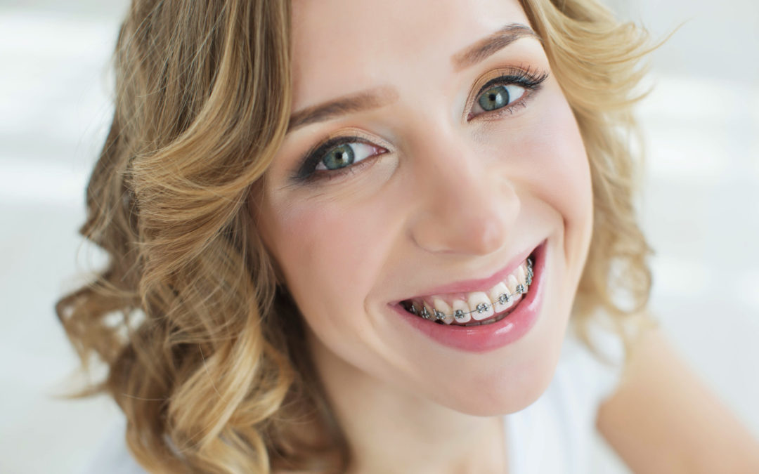 Braces as an Adult: 5 Big Benefits of Braces in Your Adult Years